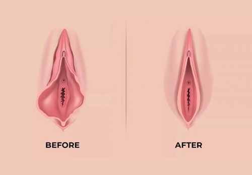 Anatomy of age-related tissue laxity and volume loss in the outer labia.